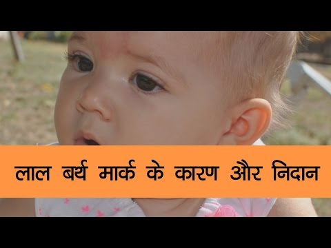 Causes and Diagnosis of Red Birthmarks - Onlymyhealth.com