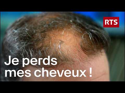 Baldness: What are the solutions to combat hair loss? | RTS