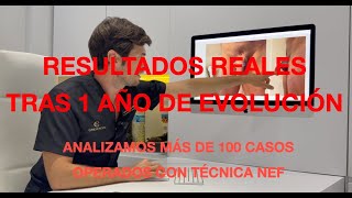 ANALIZAMOS 100 RESULTADOS REALES tras cirugía de alargamiento (más de 1 año de seguimiento)
