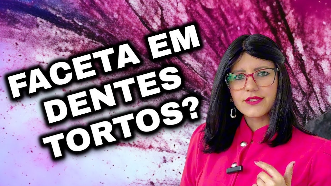 #241 POSSO FAZER FACETA EM DENTES TORTOS?