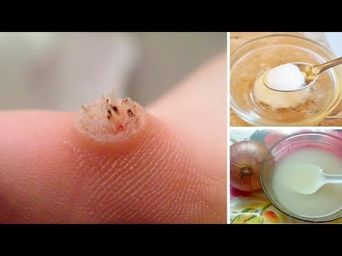 Die Abbildung nogtewogo gribka Die Rezensionen über die Effektivität lozerila