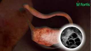 IVF, Fertility Treatment, Assisted Conception, pregnancy, Test Tube Baby | DOWNLOAD THIS VIDEO IN MP3, M4A, WEBM, MP4, 3GP ETC