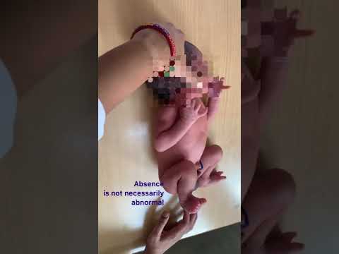 Asymmetric Tonic Neck Reflex is an important neonatal reflex. It’s absence may not be abnormal.