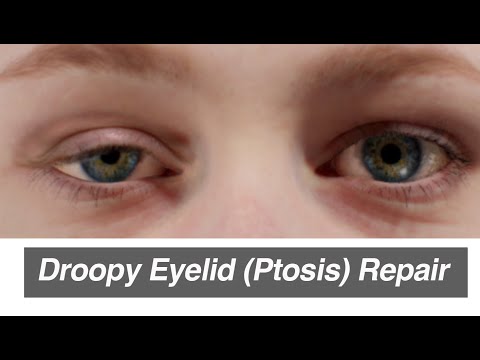 Droopy Eyelid (Ptosis) Repair