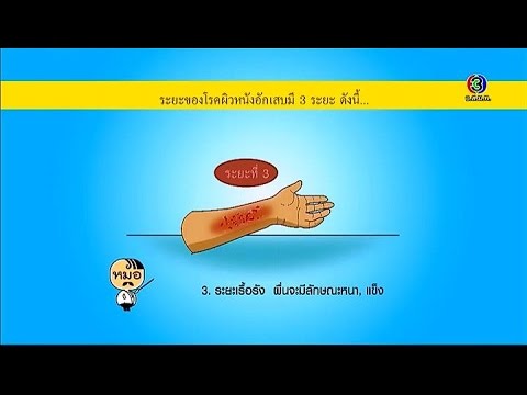 ดั้งเดิมและการรักษาของโรคสะเก็ดเงิน ราคาครีมคิงผิวหนังสะเก็ดเงิน