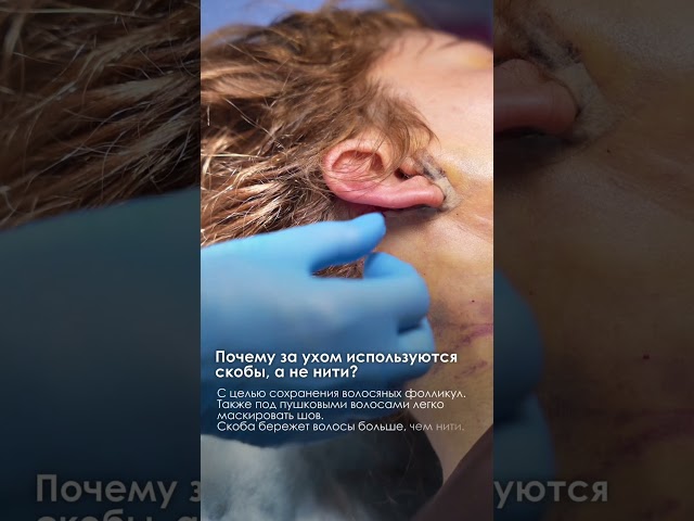 СКОБА вместо НИТИ