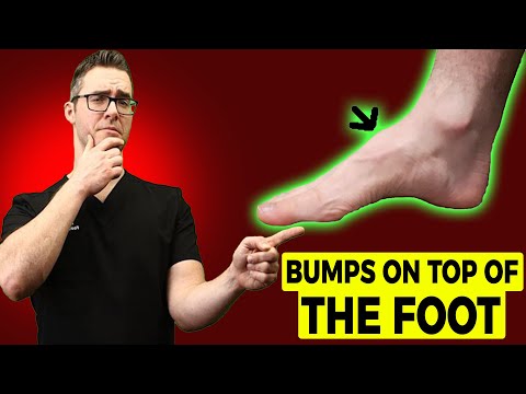 Heel Spurs Plantar Fasciitis BEST Home Treatment 2022