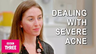 Dealing With Severe Acne: Skin