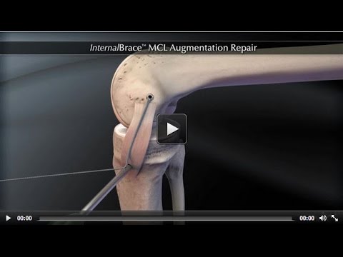 InternalBrace™ MCL Augmentation Repair