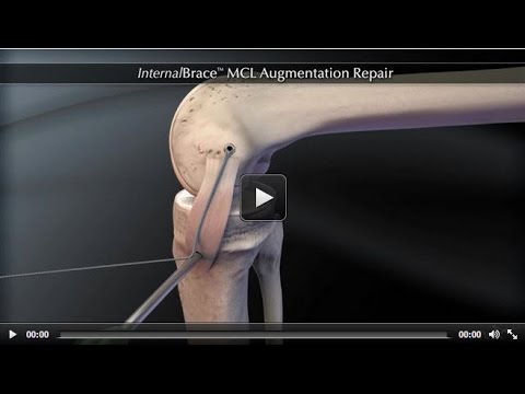 InternalBrace™ MCL-Augmentationsreparatur