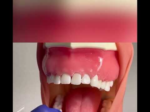 Anterior Sickle Scaler - Nevi 1