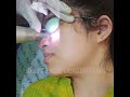 Laser Treatment for the Removal of Dark Spots