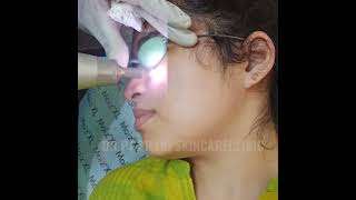 Laser Treatment for the Removal of Dark Spots