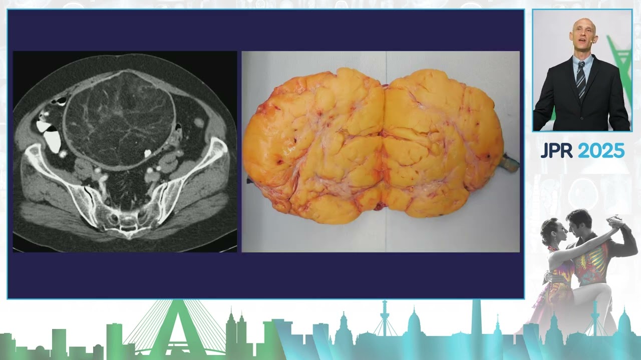 Como Estamos Lidando com Diferenciação das Massas Uterinas?