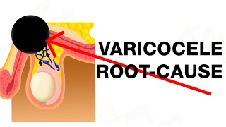 Varicocele: Treat the Root-Cause