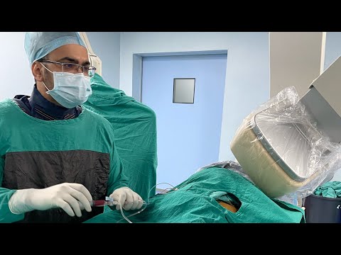 Case:-5,Angioplasty of octogenarian with IWMI, anomalous origin RCA with severe torturous course