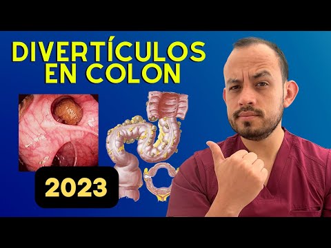 ⚠️ The 𝗠𝗲𝗷𝗼𝗿 𝗧𝗥𝗔𝗧𝗔𝗠𝗜𝗘𝗡𝗧𝗢 of Diverticular Disease (Updated For Patients)