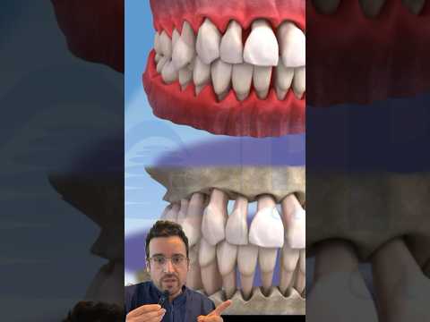 GINGIVITIS and PERIODONTITIS comparison of gum and bone