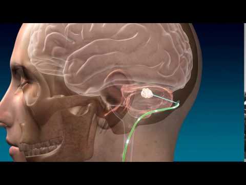 Deep Brain Stimulation for Stroke Recovery Animation