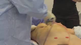 Fat Transfer to the Breasts