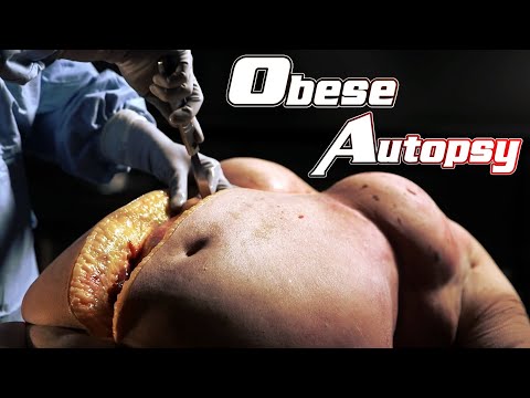 Obesity : The Post Mortem
