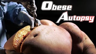 Obesity : The Post Mortem