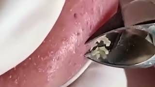 Download Lagu Relax/Satisfying/nose blackheads/tweezers/acne treatment Thumbnail