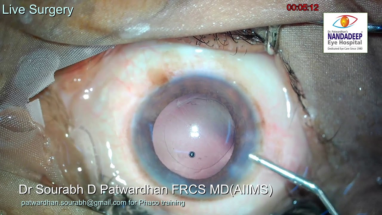 Live surgery from Nandadeep Eye Hospital Dr Sourabh Patwardhan