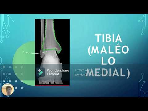 MIEMBROS INFERIORES ANATOMIA RADIOLOGICA