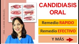 😬3 Remedios naturales para CANDIDIASIS orales/Cándida Albicans/causas-tratamiento/Episodio 61