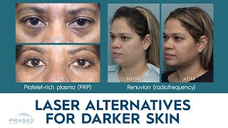 Laser Treatment Alternatives for Darker Skin