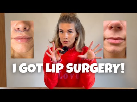 I Got Bullhorn Lip Lift Surgery 😳 | Before & After + My Honest Experience