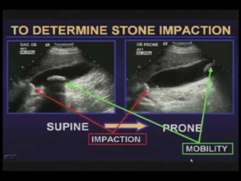 Ultrasound of the Gallbladder