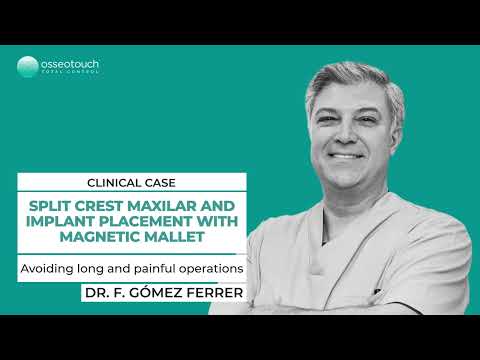 Dr. Fernando Gomez-Ferrer — split crest maxilla and implant placement with Magnetic Mallet