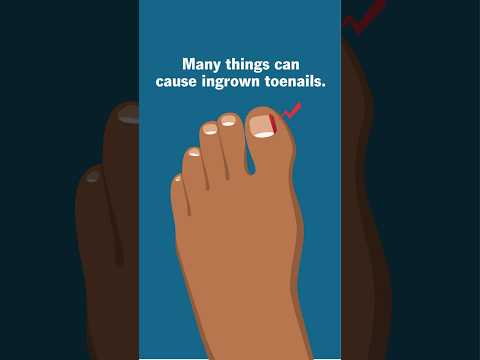 Causes of those painful ingrown toenails. Ouch!