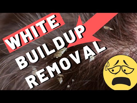 download lagu mp3 mp4 Scalp Build Up Removal, download lagu Scalp Build Up Removal gratis, unduh video klip Scalp Build Up Removal