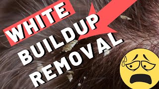 White Buildup on Scalp - How To Remove It