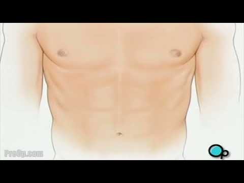 PreOp® Hernia   Hiatal Open Repair
