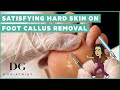 Satisfying hard skin on foot callus removal Satisfying hard skin on foot callus removal