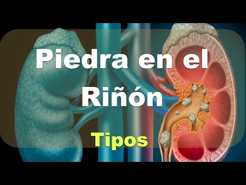 Piedra en el riñón (Litiasis renal). Tipos, comparativa