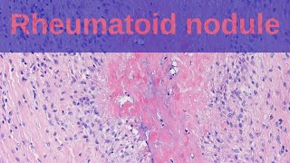 What are Rheumatoid Nodules? - Pathology mini tutorials