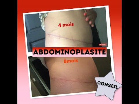 download lagu mp3 mp4 Comment Resorber Un Oedeme Post Operatoire, download lagu Comment Resorber Un Oedeme Post Operatoire gratis, unduh video klip Comment Resorber Un Oedeme Post Operatoire