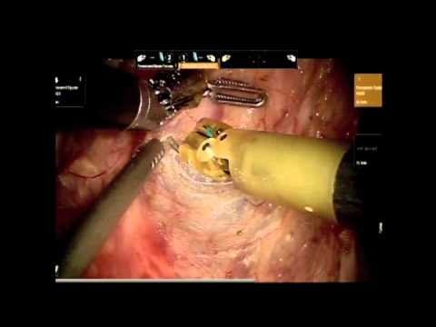 Resident Education in Robotic Surgery: Bridging The Gap with Surgical Robot in Robotic Proctectomy