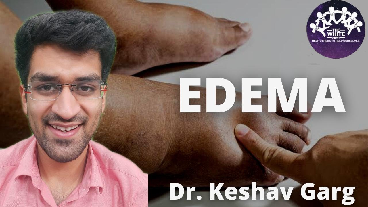 EDEMA