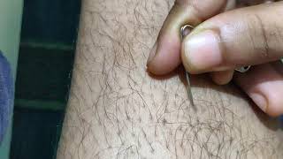 ODDLY SATISFYING removal of ingrown hair from the leg!! MUST WATCH!!