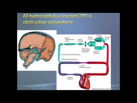 Debate: Hydrocephalus - endoscopic third ventriculostomy  vs shunts
