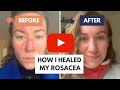 How I Healed My Rosacea: The Solution Dermatologists Don't Want You to Know About!