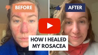 How I Healed My Rosacea: The Solution Dermatologists Don