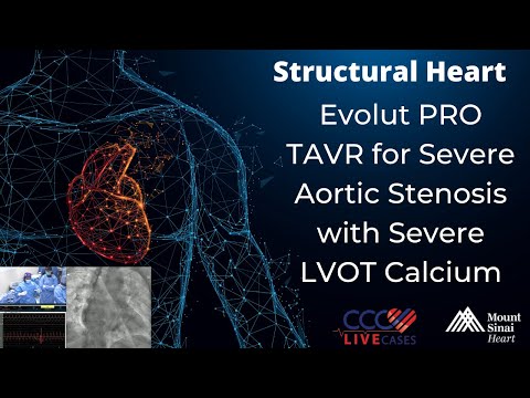 Evolut PRO TAVR for Severe Aortic Stenosis with Severe LVOT Calcium