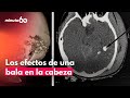 Caso Miguel Uribe Qué Secuelas Tendría Una Persona Si Recibiera Un Impacto De Bala En La Cabeza